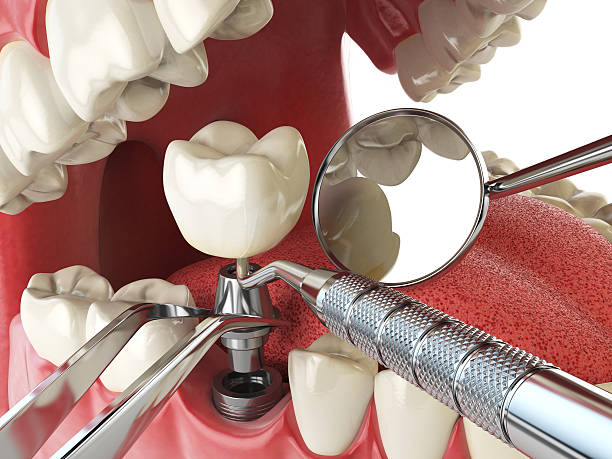 Best Emergency Wisdom Tooth Extraction in Park City, MT