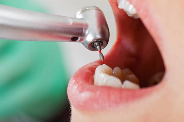 Best Broken or Chipped Tooth Repair in Park City, MT